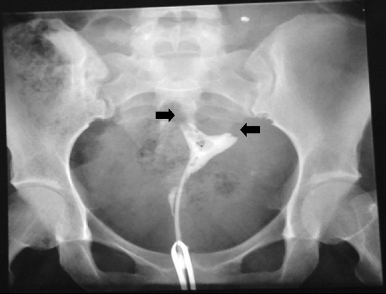 Hysterosalpingography showing bilateral tubal block (arrows).